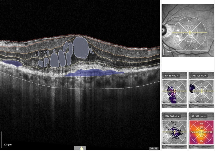RetinAI Discovery OCT scan with AI-detected retinal layers and volume metrics